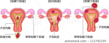 子宮肌瘤分類圖解中文 112792205
