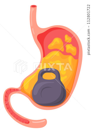 Heavy stomach syndrome. Cartoon medical problem illustration Heavy stomach syndrome. Cartoon medical problem illustration 112801722