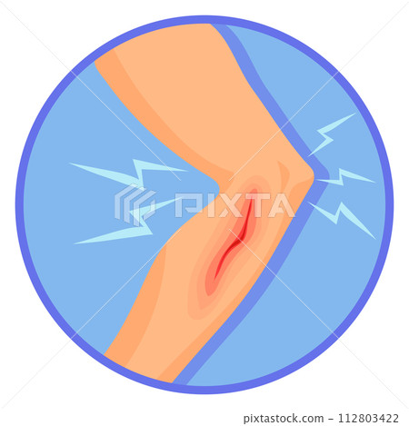 Human leg with bleeding wound. Medical injury illustration 112803422
