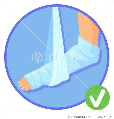 Hand in plaster cast. Broken bone medical bandage Hand in plaster cast. Broken bone medical bandage 112803423