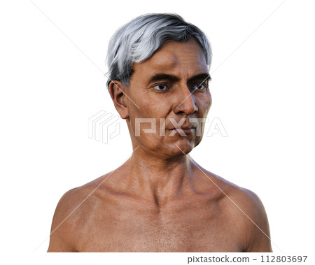 Lipoma on a man's forehead, 3D illustration. 112803697
