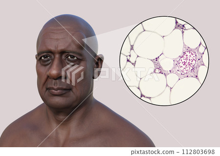 Lipoma on a man's forehead, 3D illustration and micrograph Lipoma on a man's forehead, 3D illustration and micrograph 112803698
