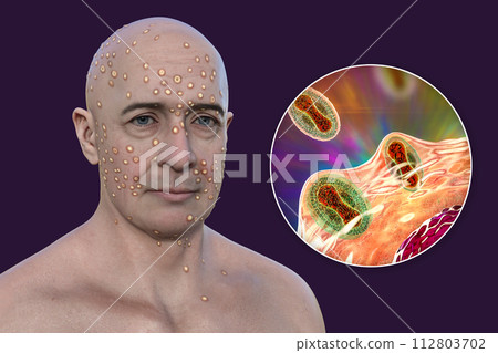 A man with rash from pox viruses, 3D illustration 112803702