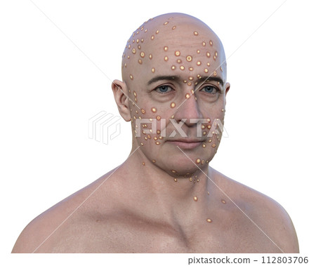 A man with rash from pox viruses, 3D illustration A man with rash from pox viruses, 3D illustration 112803706