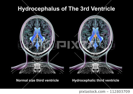 Enlargement of the third brain ventricle, 3D illustration 112803709