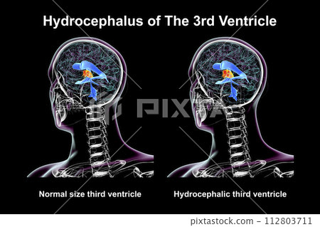 Enlargement of the third brain ventricle, 3D illustration 112803711