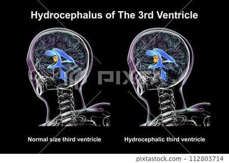 Enlargement of the third brain ventricle, 3D illustration Enlargement of the third brain ventricle, 3D illustration 112803714