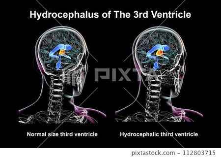 Enlargement of the third brain ventricle, 3D illustration Enlargement of the third brain ventricle, 3D illustration 112803715