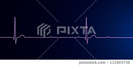 ECG of 3rd degree AV block, 3D illustration 112803730