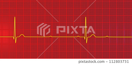 ECG of 3rd degree AV block, 3D illustration ECG of 3rd degree AV block, 3D illustration 112803731