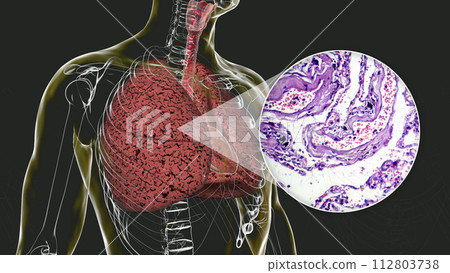 Smoker's lungs, 3D illustration along with a photomicrograph Smoker's lungs, 3D illustration along with a photomicrograph 112803738