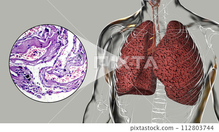 Smoker's lungs, 3D illustration along with a photomicrograph Smoker's lungs, 3D illustration along with a photomicrograph 112803744