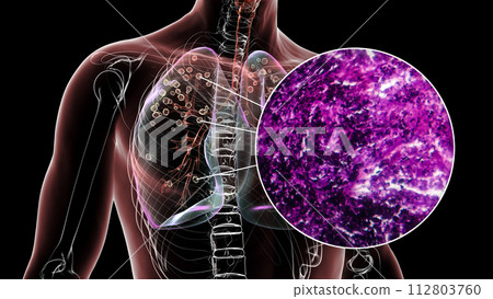 Lungs affected by silicosis, 3D illustration and micrograph 112803760