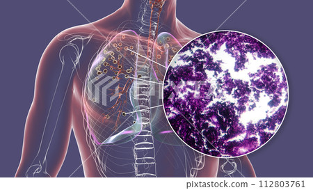 Lungs affected by silicosis, 3D illustration and micrograph 112803761
