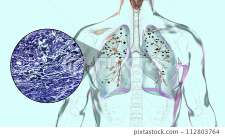 Lungs affected by silicosis, 3D illustration and micrograph 112803764
