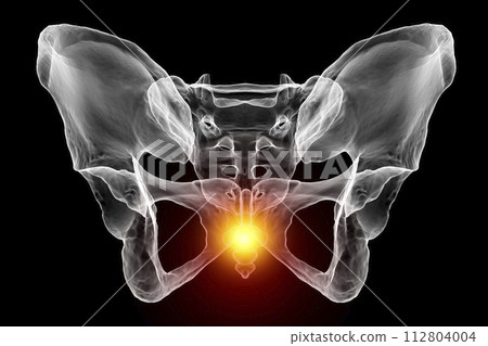 A 3D medical illustration highlighting the coccyx bone marked in red, depicting coccyx pain 112804004