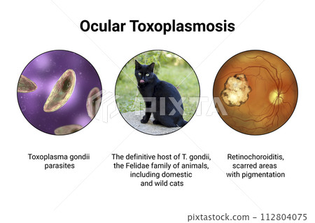 Ocular toxoplasmosis, retinal scar caused by a Toxoplasma gondii infection, scientific illustration Ocular toxoplasmosis, retinal scar caused by a Toxoplasma gondii infection, scientific illustration 112804075