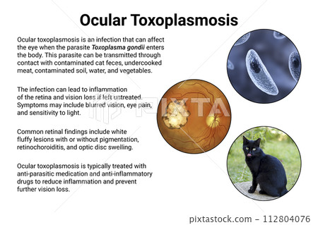 Ocular toxoplasmosis, retinal scar caused by a Toxoplasma gondii infection, scientific illustration 112804076
