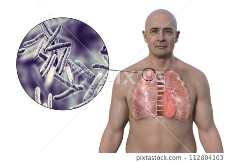 A man with tuberculosis and close-up view of Mycobacterium tuberculosis bacteria, 3D illustration A man with tuberculosis and close-up view of Mycobacterium tuberculosis bacteria, 3D illustration 112804103