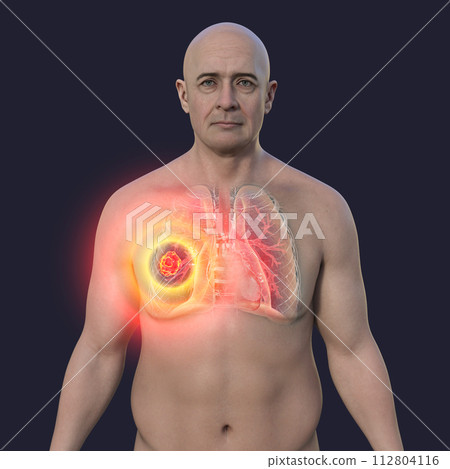 A man with lung mucormycosis lesion, 3D illustration 112804116