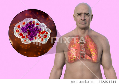 Lung histoplasmosis, a fungal infection caused by Histoplasma capsulatum, 3D illustration Lung histoplasmosis, a fungal infection caused by Histoplasma capsulatum, 3D illustration 112804144