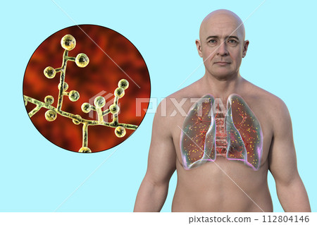 A man with lung adiaspiromycosis, 3D illustration featuring small nodules in the lungs A man with lung adiaspiromycosis, 3D illustration featuring small nodules in the lungs 112804146