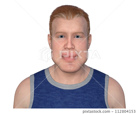Acromegaly in a man, 3D illustration 112804153