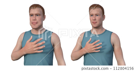 Acromegaly in a man, and the same healthy person, 3D illustration 112804156
