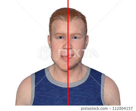 Acromegaly in a man, and the same healthy person, 3D illustration 112804157