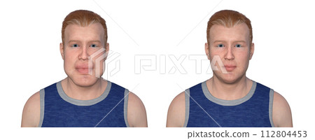 Acromegaly in a man, and the same healthy person, 3D illustration 112804453