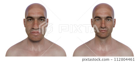 Acromegaly in a man, and the same healthy man, 3D illustration Acromegaly in a man, and the same healthy man, 3D illustration 112804461