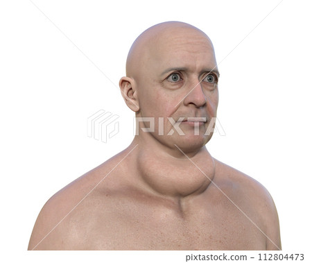 A man with enlarged thyroid gland, 3D illustration A man with enlarged thyroid gland, 3D illustration 112804473