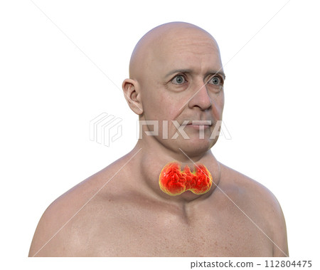 A man with enlarged thyroid gland, 3D illustration A man with enlarged thyroid gland, 3D illustration 112804475