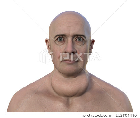 A man with enlarged thyroid gland, 3D illustration A man with enlarged thyroid gland, 3D illustration 112804480
