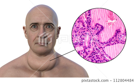 A man with enlarged thyroid gland, 3D illustration, and micrograph toxic goiter A man with enlarged thyroid gland, 3D illustration, and micrograph toxic goiter 112804484