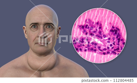 A man with enlarged thyroid gland, 3D illustration, and micrograph toxic goiter A man with enlarged thyroid gland, 3D illustration, and micrograph toxic goiter 112804485