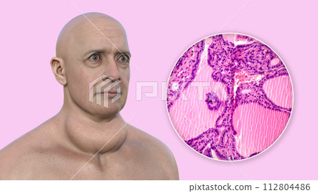 A man with enlarged thyroid gland, 3D illustration, and micrograph toxic goiter A man with enlarged thyroid gland, 3D illustration, and micrograph toxic goiter 112804486