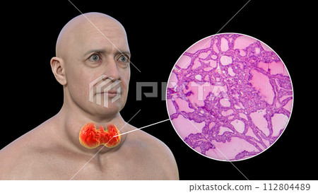 A man with enlarged thyroid gland, 3D illustration, and micrograph toxic goiter A man with enlarged thyroid gland, 3D illustration, and micrograph toxic goiter 112804489