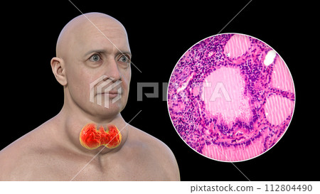 A man with enlarged thyroid gland, 3D illustration, and micrograph toxic goiter 112804490