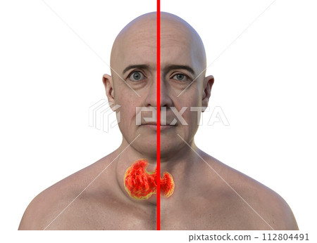 A man with enlarged thyroid gland, 3D illustration A man with enlarged thyroid gland, 3D illustration 112804491