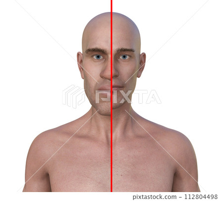 Acromegaly in a man, and the same healthy person, 3D illustration Acromegaly in a man, and the same healthy person, 3D illustration 112804498