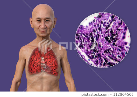 A man with smoker's lungs, 3D illustration and micrograph A man with smoker's lungs, 3D illustration and micrograph 112804505