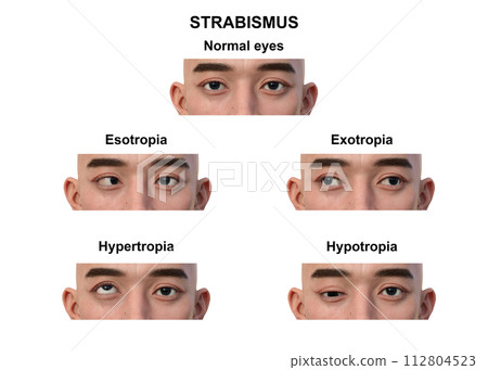 A man with various strabismus types, 3D illustration 112804523
