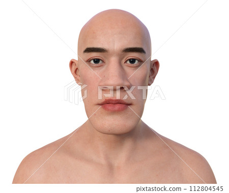 Acromegaly in a man, 3D illustration 112804545