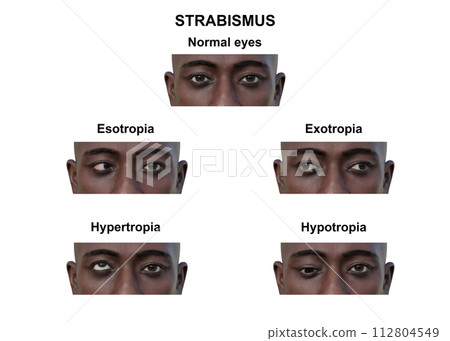 A man with various strabismus types, 3D illustration 112804549