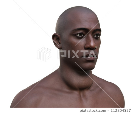 A man with enlarged thyroid gland, 3D illustration A man with enlarged thyroid gland, 3D illustration 112804557