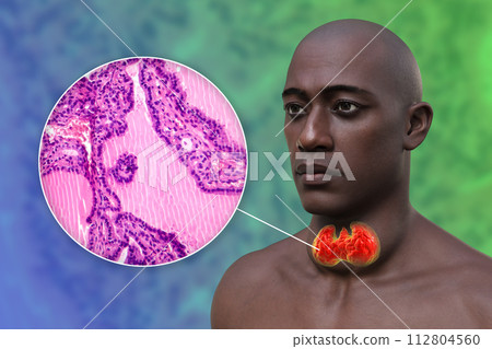 A man with enlarged thyroid gland, 3D illustration, and micrograph toxic goiter A man with enlarged thyroid gland, 3D illustration, and micrograph toxic goiter 112804560