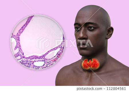 A man with enlarged thyroid gland, 3D illustration, and micrograph of endemic goiter A man with enlarged thyroid gland, 3D illustration, and micrograph of endemic goiter 112804561