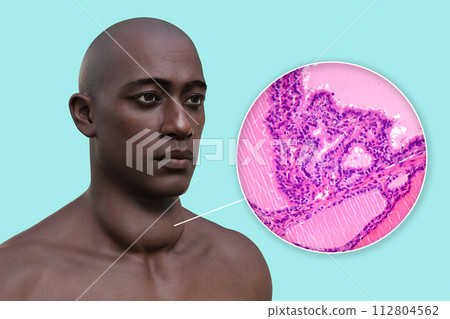 A man with enlarged thyroid gland, 3D illustration, and micrograph toxic goiter A man with enlarged thyroid gland, 3D illustration, and micrograph toxic goiter 112804562