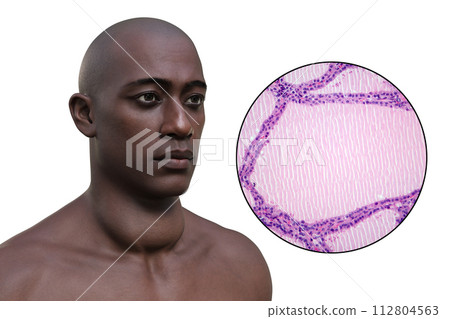 A man with enlarged thyroid gland, 3D illustration, and micrograph of endemic goiter 112804563